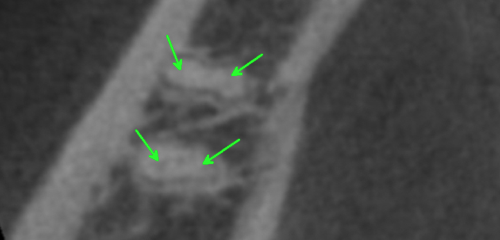Axial Slice in the apical third of the root suggesting the presence of separate portals of exit for each canal.