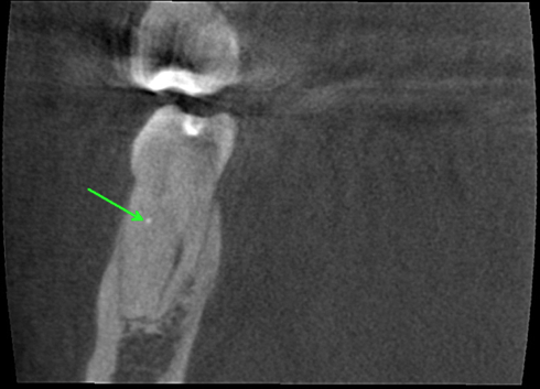 Mesial Root, Coronal View, Arrow on CAOH placed at apical extent of trough, indicating that my path was centered within the canal and “on target” to locate the orifice. 